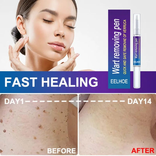 Wipe Off Tags and Mole Remover Pen